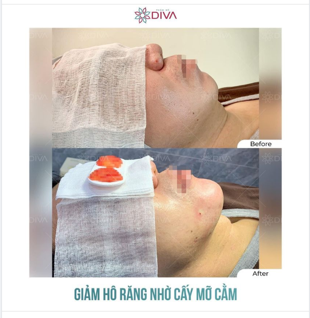 GIẢM HÔ MIỆNG VỚI CẤY MỠ COLEMAN CẰM