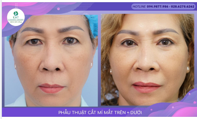 Hai mắt không đều, tầm nhìn bị giới hạn do mí mắt bị lão hoá, da dư xuất hiện hai bên không cân đối là những nguyên nhân khiến nhiều chị em cảm thấy không đẹp, thiếu tự tin.