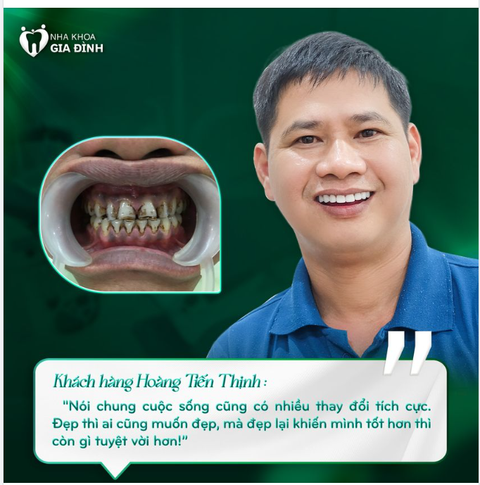 HÀM RĂNG NHIỄM MÀU DO HÚT THUÔC LÂU NĂM CÓ THỂ THAY ĐỔI ĐẾN MỨC NÀO?