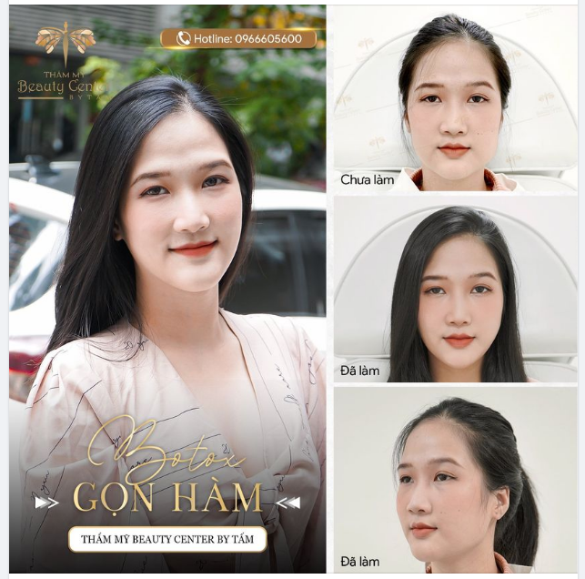HÀM THON GỌN KHÔNG CẦN PHẪU THUẬT