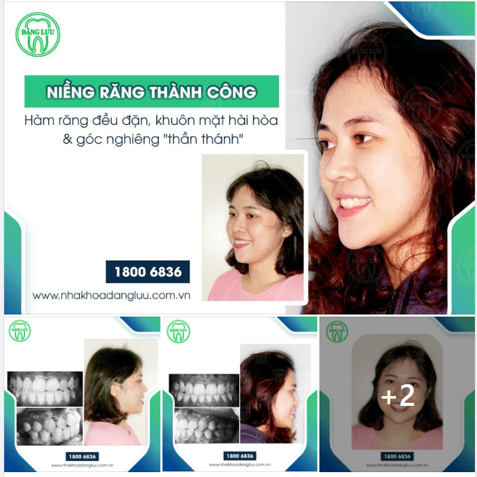 Hàng triệu người chọn niềng răng để thay đổi tình trạng sai lệch khớp cắn của mình, và họ đã thành công với sự lựa chọn ấy.