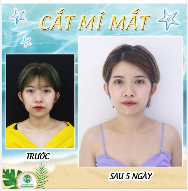 HÀNH TRÌNH 5 NGÀY SỞ HỮU MẮT 2 MÍ ĐẸP RẠNG NGỜI