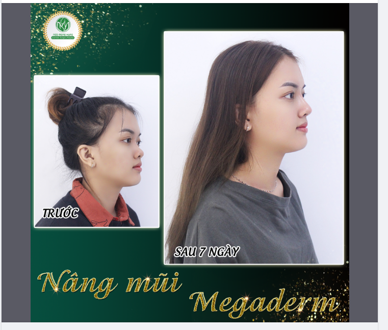 HÀNH TRÌNH 7 NGÀY SỞ HỮU DÁNG MŨI ĐẸP