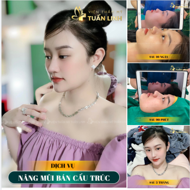 Hành trình hóa Hotgirl sau 5 tháng nâng mũi bán cấu trúc tại Tuấn Linh