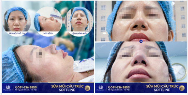 Hành trình  Tái sinh mũi hỏng - Vực dậy niềm tin của Dr Vũ Quang vẫn diễn ra mỗi ngày.