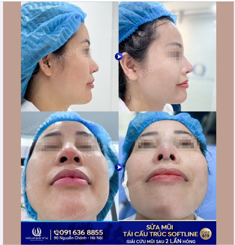 Hành trình  TÁI SINH MŨI HỎNG - VỰC DẬY NIỀM TIN của Dr Vũ Quang vẫn diễn ra mỗi ngày.