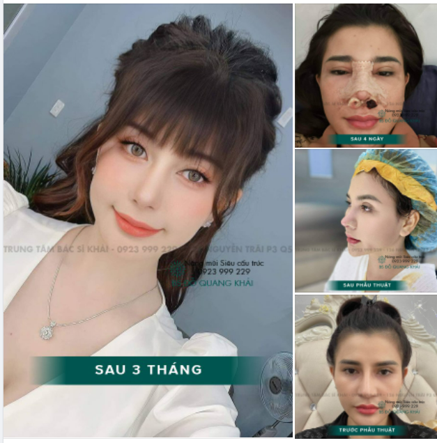 HÀNH TRÌNH TRẺ HÓA CỦA KHÁCH HÀNG NHÀ BS KHẢI- NÂNG MŨI SIÊU CẤU TRÚC, KĨ THUẬT ĐỘC QUYỀN CỦA BS