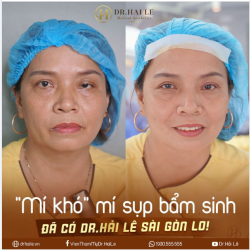 HẾT SẢY CON BÀ BẢY VỚI KẾT QUẢ MỘT TRỜI MỘT VỰC sau khi phẫu thuật chỉnh hình sụp mí bẩm sinh tại Dr.Hải Lê!