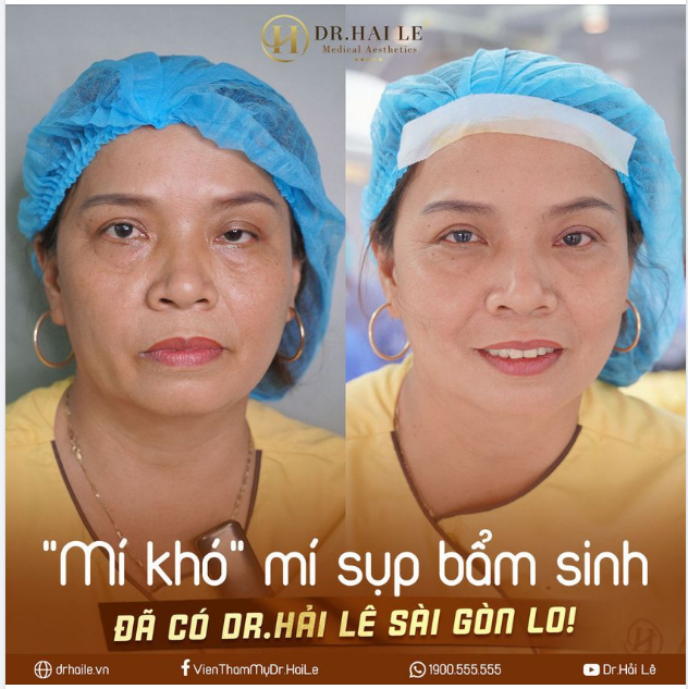 HẾT SẢY CON BÀ BẢY VỚI KẾT QUẢ MỘT TRỜI MỘT VỰC sau khi phẫu thuật chỉnh hình sụp mí bẩm sinh tại Dr.Hải Lê!