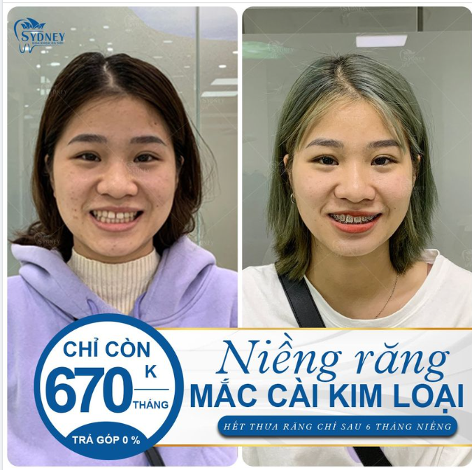 HẾT THƯA RĂNG CHỈ SAU 6 THÁNG NIỀNG