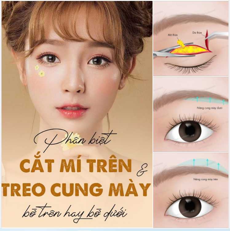 HIỆU QUẢ KHÁC NHAU GIỮA PHẪU THUẬT CẮT MÍ TRÊN-DƯỚI VÀ N NG CUNG MÀY TRÊN-DƯỚI