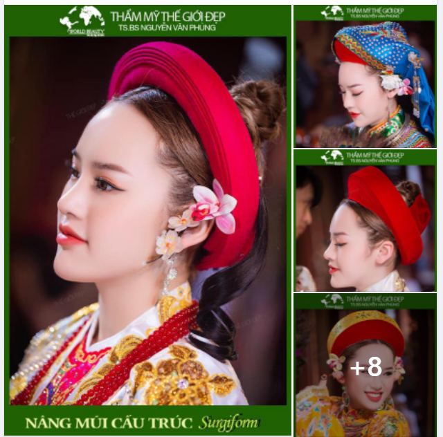 Hiệu quả ngay lần đầu tiên N.âng cấp dung nhan cho quý Cô bằng giải pháp N.âng mũi cấu trúc Surgiform kết hợp sụn tự thân