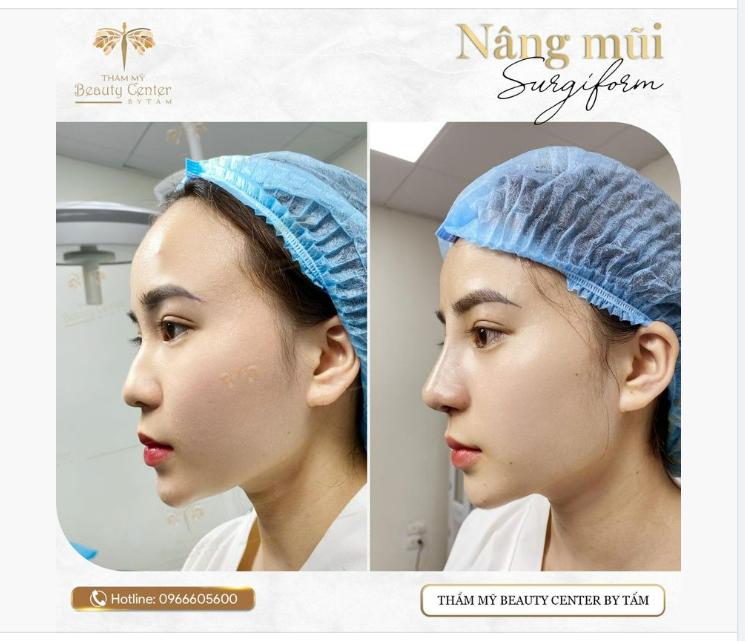 Hình ảnh thực tế của khách hàng trước và sau khi nâng mũi Surgiform