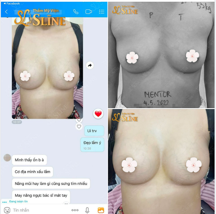 ​​​​​​​ Hình ảnh thực tế khách hàng nâng ngực với Ekip Sline phẫu thuật tại bệnh viện đa khoa quốc tế Bắc Hà.