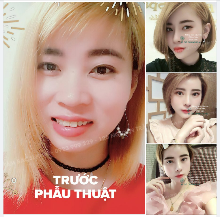 HÓA THÂN HOTGIRL SAU LẦN CHỈNH SỬA COMBO 3 DV, NÂNG MŨI CẤU TRÚC. CẮT MÍ, ĐỘN CẰM