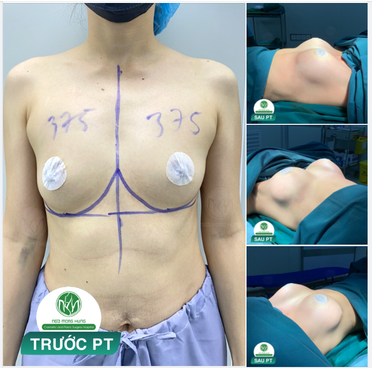 HOÀN THÀNH CA NÂNG NGỰC 375cc