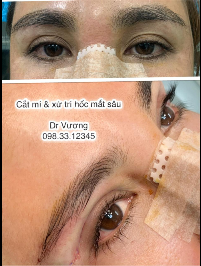 Hốc mắt thiếu mỡ thì nhìn phần mắt khá già nua nên ko biết cách lấy mỡ thì tốt nhất các bạn ko cho ai lấy mỡ mí trên ( cả mí dưới nhé)  lấy xong sẽ lõm vôm gây trũng sâu, già nua ...