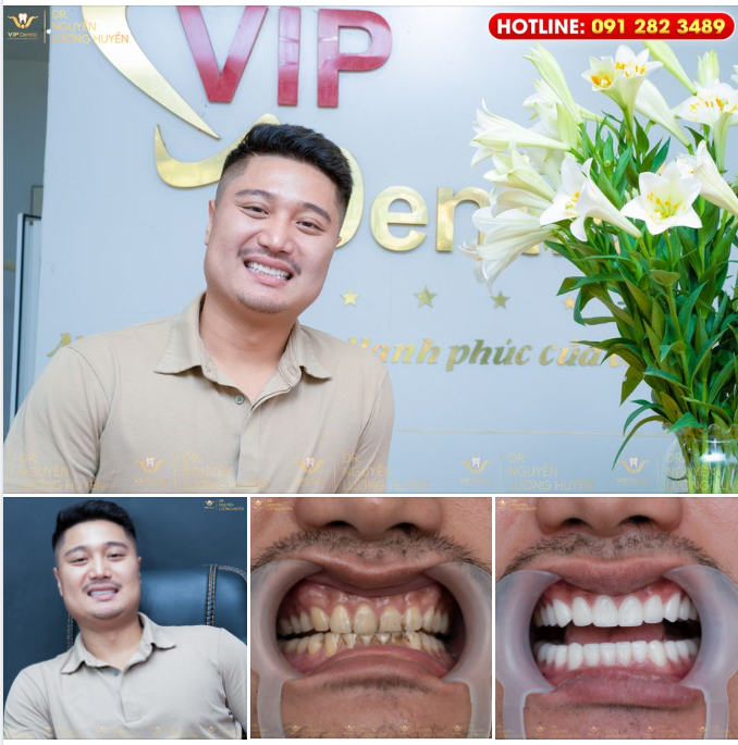 HT SMILE - NÂNG TẦM PHONG ĐỘ CÁNH MÀY RÂU; BẢO VỆ SỨC KHỎE LÂU DÀI