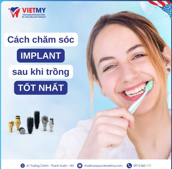 Hướng dẫn chăm sóc Implant sau khi trồng răng tốt nhất