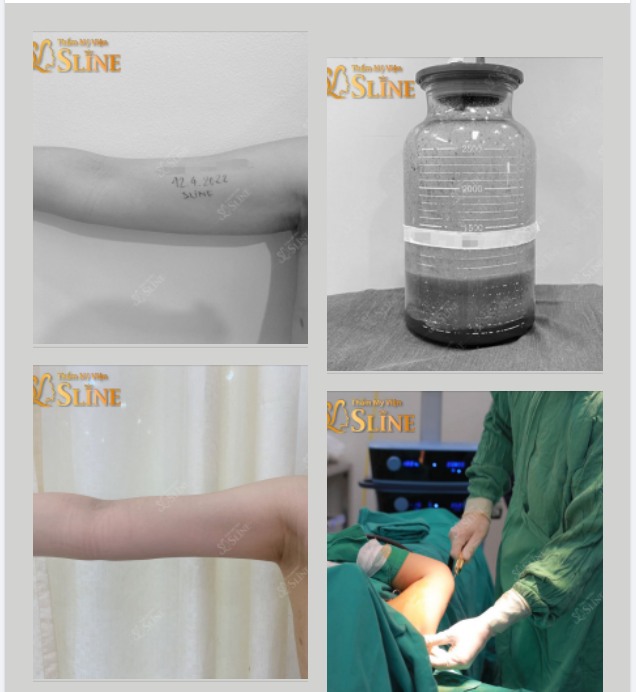 HÚT MỠ CÁNH TAY - ĐẸP NGAY TỨC THÌ