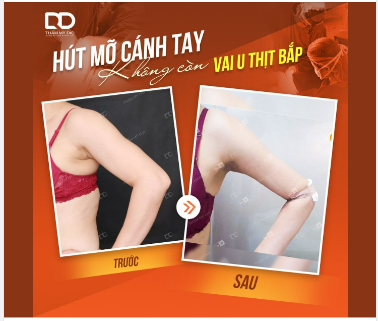 HÚT MỠ CÁNH TAY - XÓA SỔ VAI U THỊT BẮP