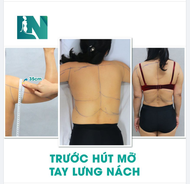 HÚT MỠ TẠO DÁNG THẨM MỸ, CẤY MỠ NGỰC CHO CHỊ KH (49 TUỔI) TIN TƯỞNG EKIP BÁC SĨ LƯƠNG NGỌC VÌ ĐƯỢC BẠN TỪNG THỰC HIỆN GIỚI THIỆU