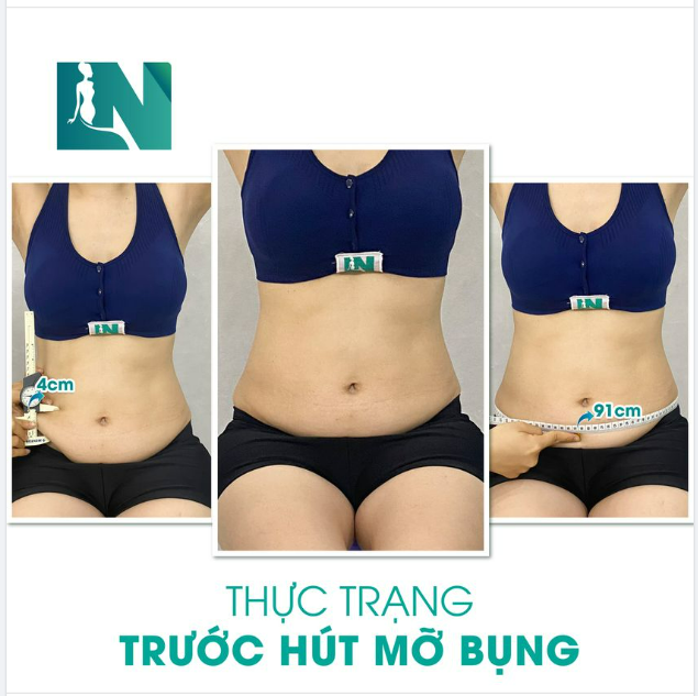 HÚT MỠ TẠO DÁNG THẨM MỸ CHO CHỊ KH (34 TUỔI) TỪNG ĐẶT TÚI NGỰC BÁC SĨ LƯƠNG NGỌC 1 NĂM TRƯỚC.