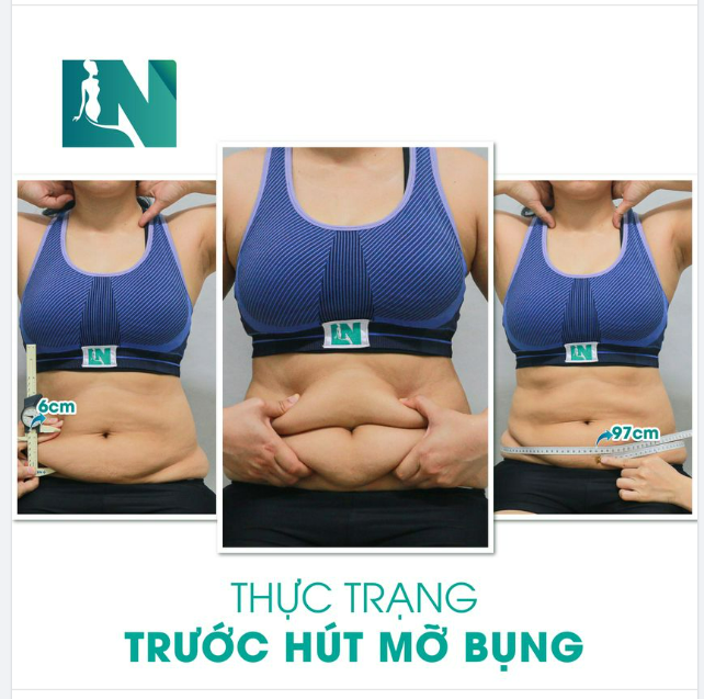 HÚT MỠ TẠO DÁNG THẨM MỸ CHO CHỊ KH (35 TUỔI) TỪNG TIÊM TAN MỠ, UỐNG THUỐC GIẢM CÂN, CHẠY MÁY MASSAGE KHIẾN DA BỤNG CHÙNG NHÃO, CHẢY XỆ