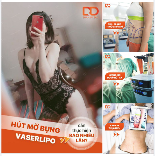 HÚT MỠ VASERLIPO CẦN THỰC HIỆN BAO NHIÊU LẦN