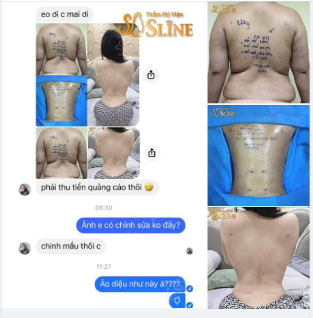Hút mỡ với công nghệ Vaserlipo Mãi Đỉnh kết hợp với tay nghề bác sỹ tại Thẩm Mỹ Viện Sline sẽ ra được kết quả như thế này đây combo Eo - Lưng - Tay - Đùi