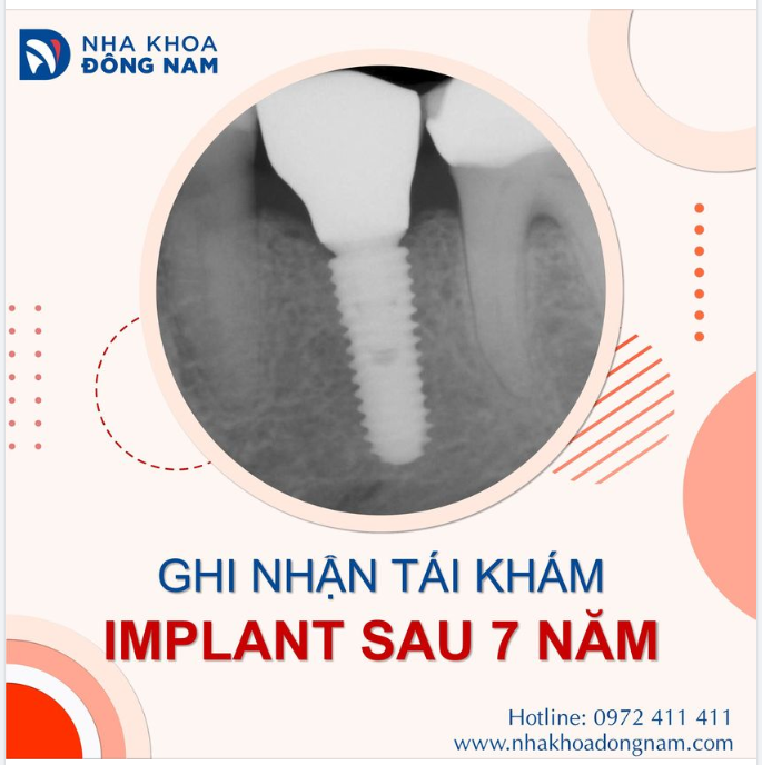 Implant sau 7 năm của bệnh nhân N.Minh (35 tuổi, Gò Vấp) vẫn duy trì ở mức hoàn hảo