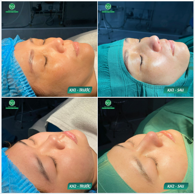 KẾT QUẢ 2 CA NÂNG MŨI CHO 2 KHÁCH HÀNG