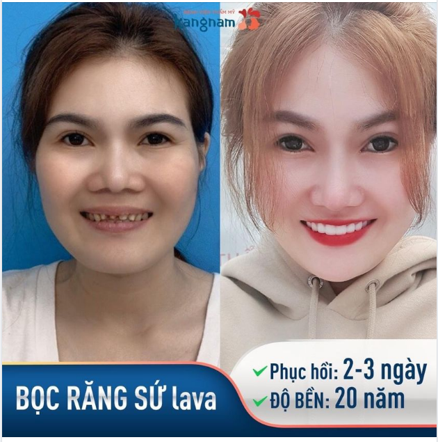 Kết quả Bọc răng sứ Perfect Smile toàn hàm - 20 chiếc răng