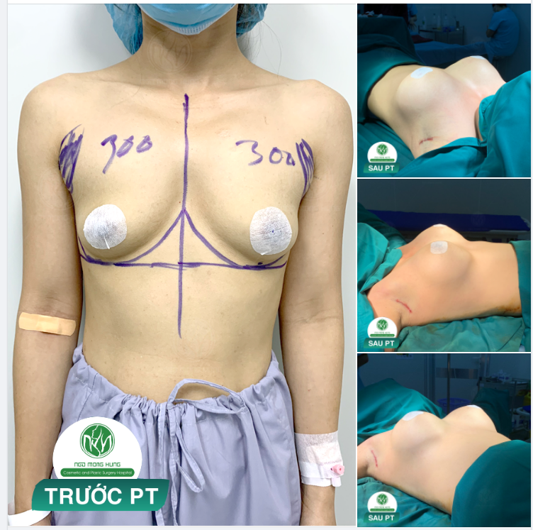 KẾT QUẢ CA NÂNG NGỰC ĐẶT TÚI SIZE 300cc