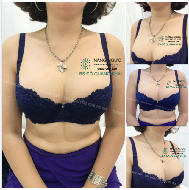 KẾT QUẢ NÂNG NGỰC THU QUẦNG SAU 1 THÁNG
