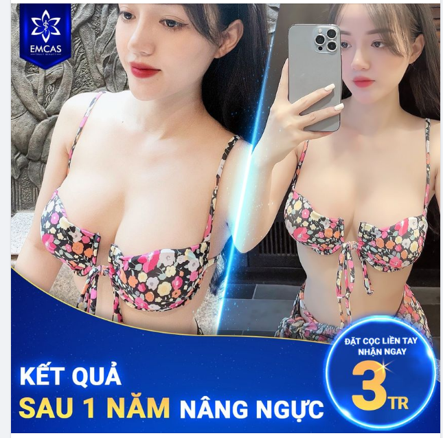 KẾT QUẢ SAU 1 NĂM NÂNG NGỰC