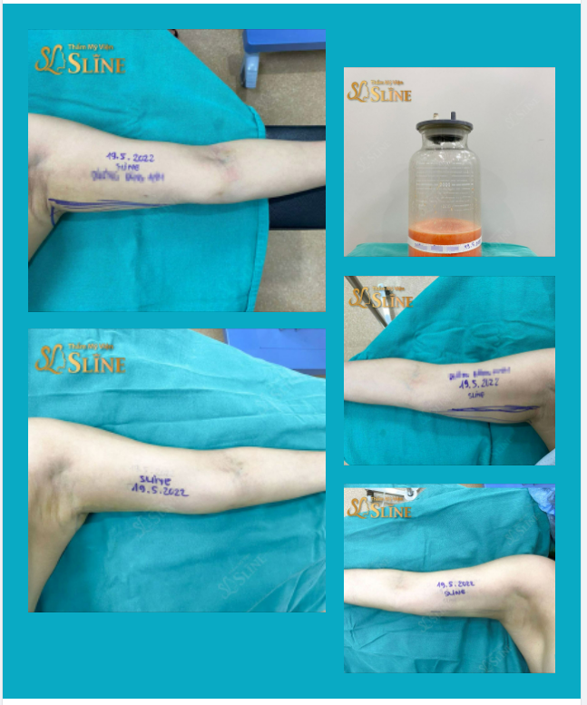 Kết quả sau ca hút mỡ cánh tay,