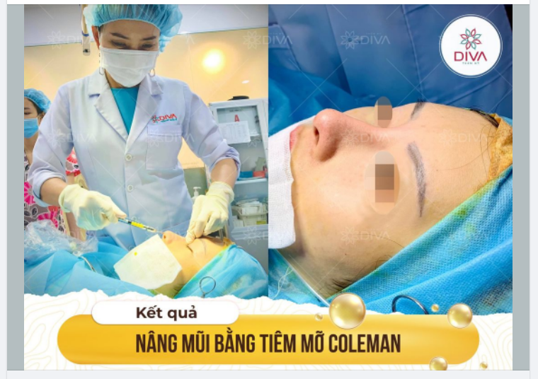 KẾT QUẢ THẨM MỸ SAU CẤY MỠ COLEMAN MŨI