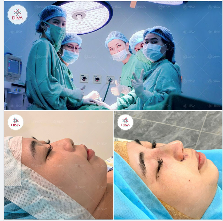 KẾT QUẢ THẨM MỸ DÁNG MŨI XINH, HÀI HÒA SAU NÂNG MŨI