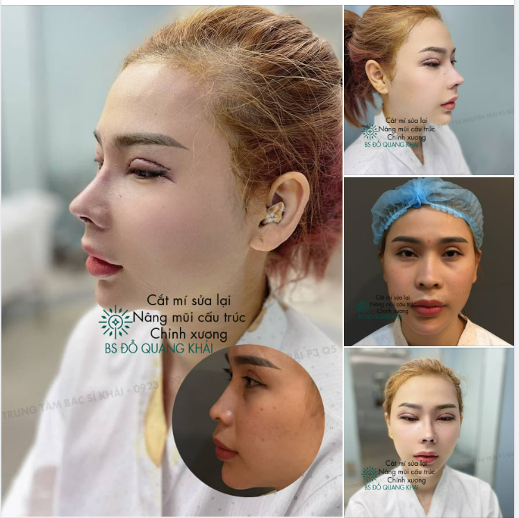 Kết quả thực tế khách hàng cắt mí sửa lại - mở góc mắt trong - nâng mũi cấu trúc - chỉnh xương