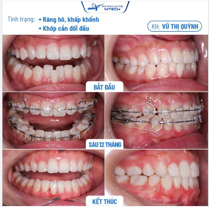KHẮC PHỤC RĂNG HÔ, CHEN CHÚC, KHẤP KHỂNH NHỜ NIỀNG RĂNG X - MATRIX