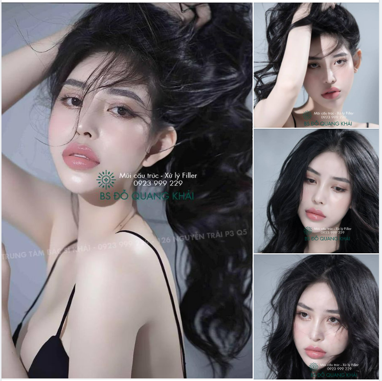 KHÁCH HÀNG NÂNG MŨI BÊN NHÀ BS Đỗ Quang Khải HƠN 3 NĂM