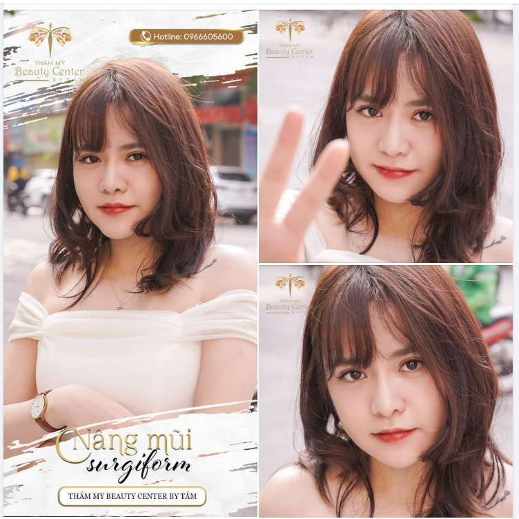 Khách hàng nâng mũi Surgiform tại Thẩm Mỹ Beauty Center By Tấm sau 2 năm đẹp xuất sắc!!