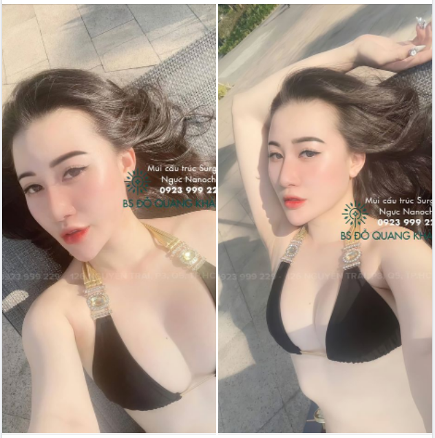 Khách hàng nâng ngực và mũi gửi feedback cho bác sĩ đây ạ.