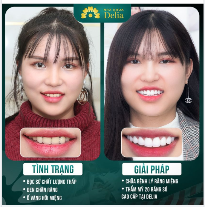 Khách hàng Phương Anh từng bọc sứ hỏng với hiện tượng: răng ố vàng - thâm đen, viêm lợi - hơi thở có mùi