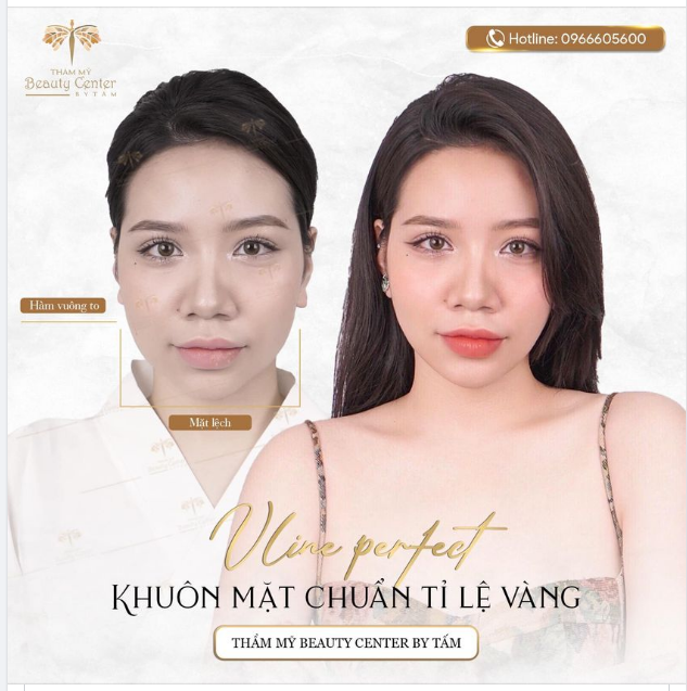 Khách hàng thay đổi ngoạn mục sau khi làm thon gọn hàm tại TMV Tấm