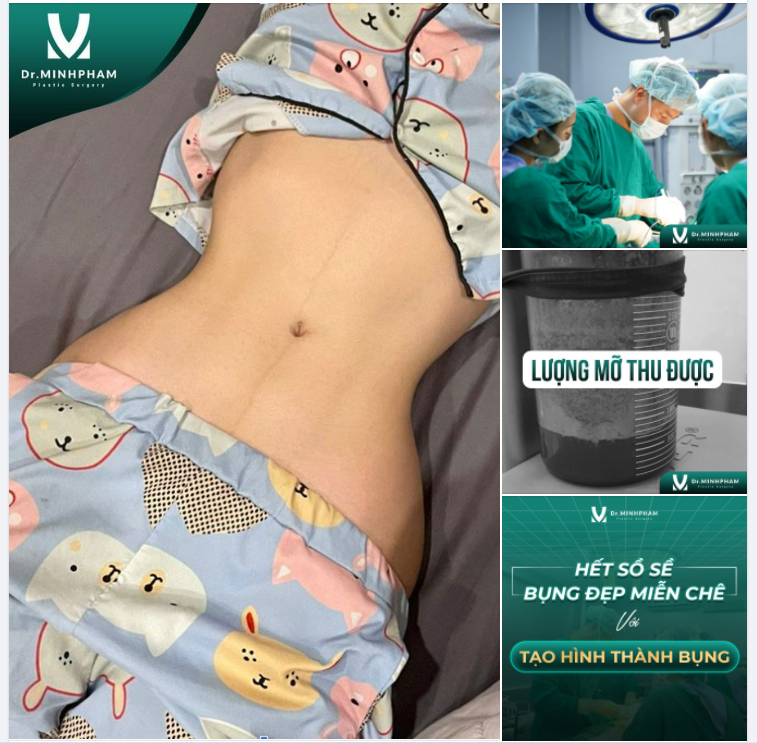 Khách hàng thực hện hút mỡ 