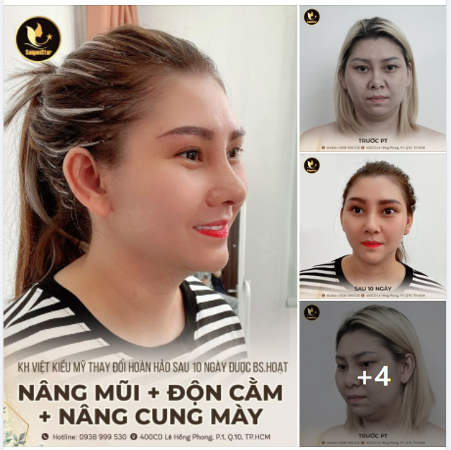 Khách hàng Việt Kiều Mỹ thay đổi hoàn hảo sau 10 ngày được Bác sĩ Hoạt NÂNG MŨI + ĐỘN CẰM + NÂNG CUNG MÀY
