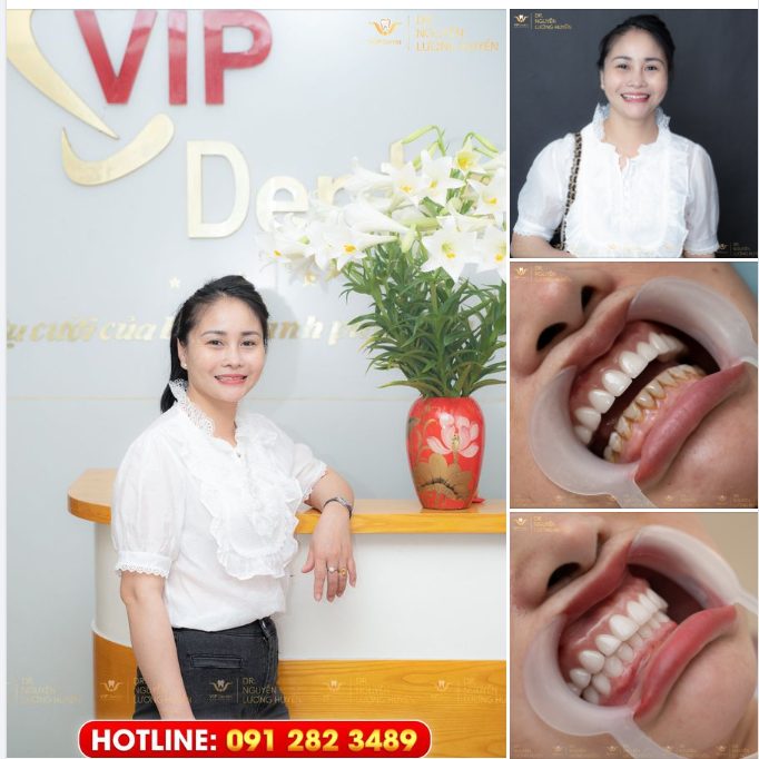 KHÁCH HÀNG XINH ĐẸP HOÀN THIỆN THÊM 10 RĂNG SỨ HÀM DƯỚI