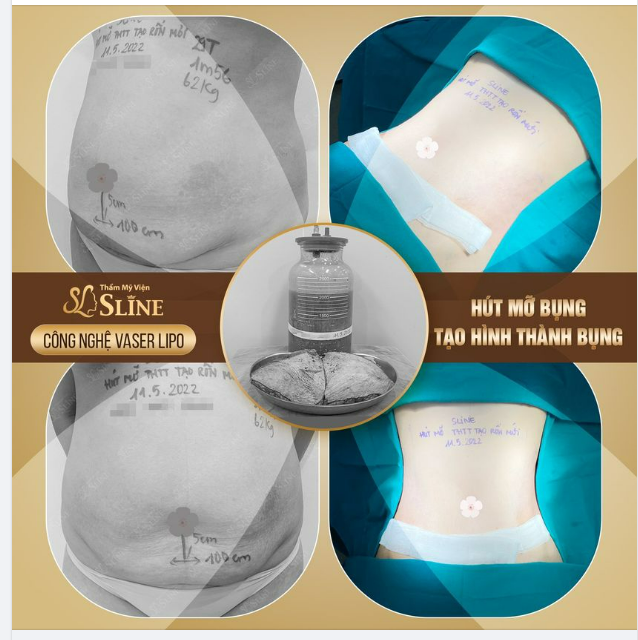 Khi công nghệ Vaserlipo kết hợp với Bác sỹ của Thẩm Mỹ Viện Sline sẽ ra được kết quả như thế này đây